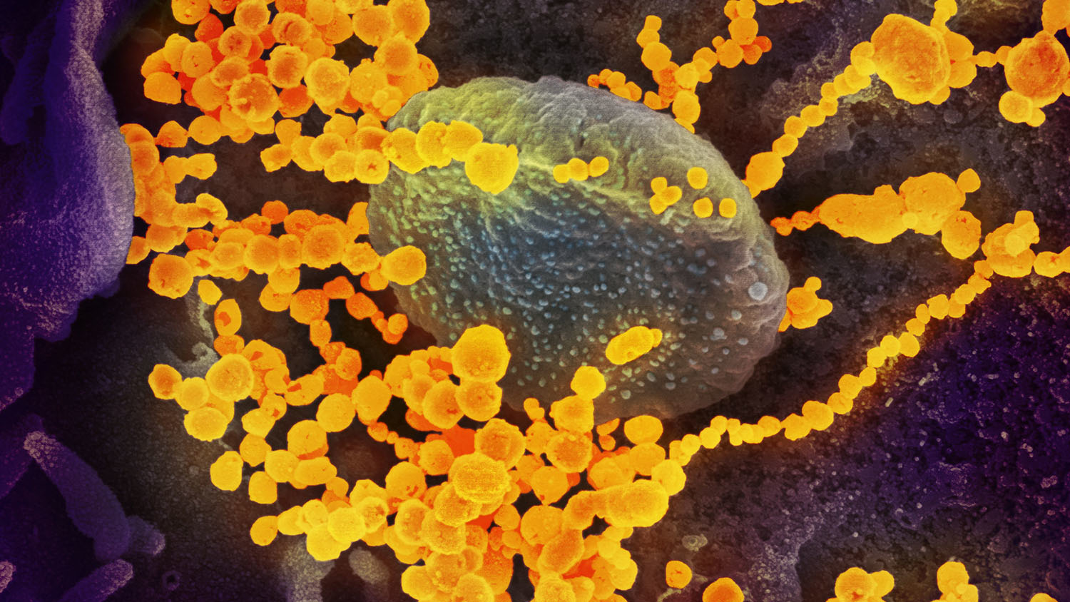 This scanning electron microscope image shows SARS-CoV-2 (round gold objects) emerging from the surface of cells cultured in the lab